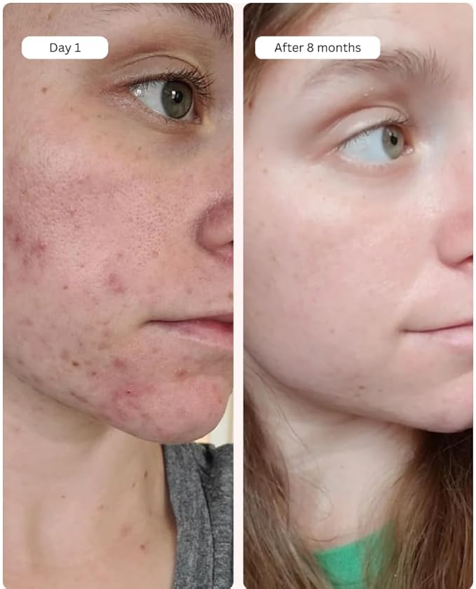 Averr Aglow Clear Skin Elixir, Face Mask Prevent Breakouts, Clear Acne & Oily Skin, Fade Scars Marks, Natural Skincare Solution, Reducer & Pores Cleanser Treatment, Natural Younger Looking Skin