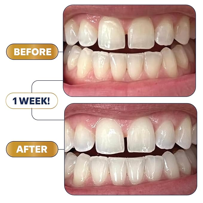 Lumineux 2-in-1 Whitening Pen (1 Pack) Enamel Safe and Clinically Proven to Whiten Without The Sensitivity - Removes Coffee, Tea, and Smoking Stains