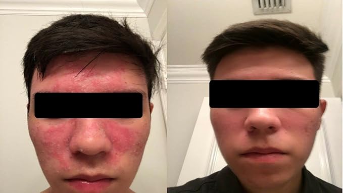 Seborrheic Dermatitis Face Cream - Skin Rejuvenation and Barrier Repair with MCT Oil, Squalane - Moisturizing Face, Scalp and Body Cream for Sensitive Skin Seb Derm - No Steroids for Lasting Results