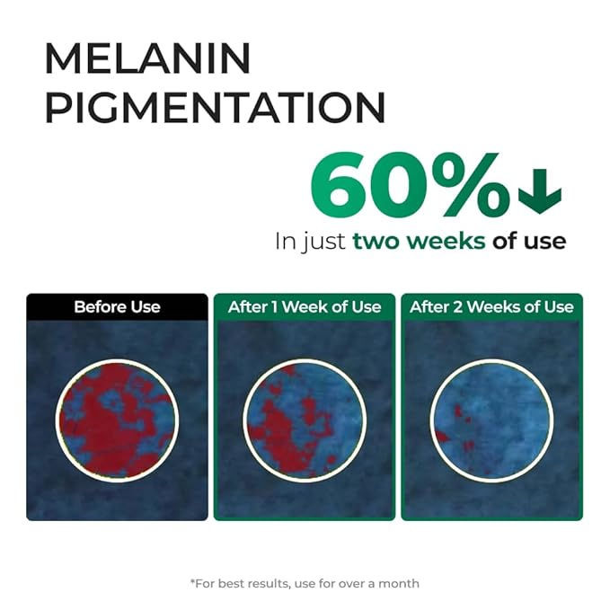 EASYDEW Dark Spot Correcting Serum for Uneven Skin Tone & Dull Skin – EGF, Niacinamide & Glutathione, Anti-Aging Formula, 30ml