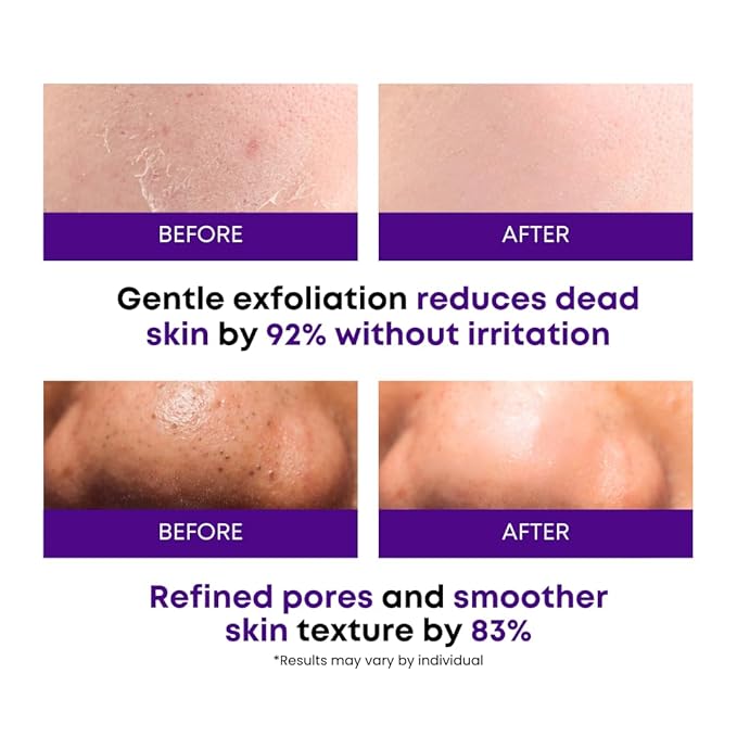 Eggplant Peeling Toner Pads – Korean Toner Pads Exfoliating, Dual Action for Pore Care & Skin Barrier, Improves Rough and Dull Skin, Removes Dead Skin & Blackheads, Dual Side Cotton, 50 Pad