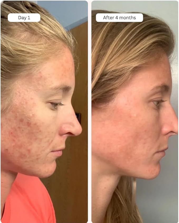 Averr Aglow Clear Skin Elixir, Face Mask Prevent Breakouts, Clear Acne & Oily Skin, Fade Scars Marks, Natural Skincare Solution, Reducer & Pores Cleanser Treatment, Natural Younger Looking Skin