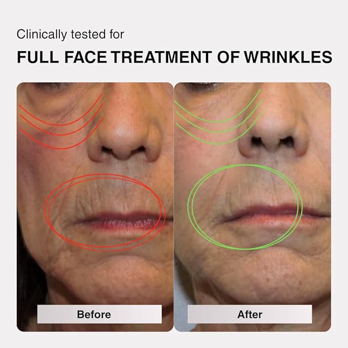 VogueNow LED Light Therapy Mask - FDA-Cleared Device for Wrinkles & Acne - Red Light Therapy for Face with Chin & Lip Coverage - Red, Blue & Near Infrared Facial Skincare Device with 280 LEDs