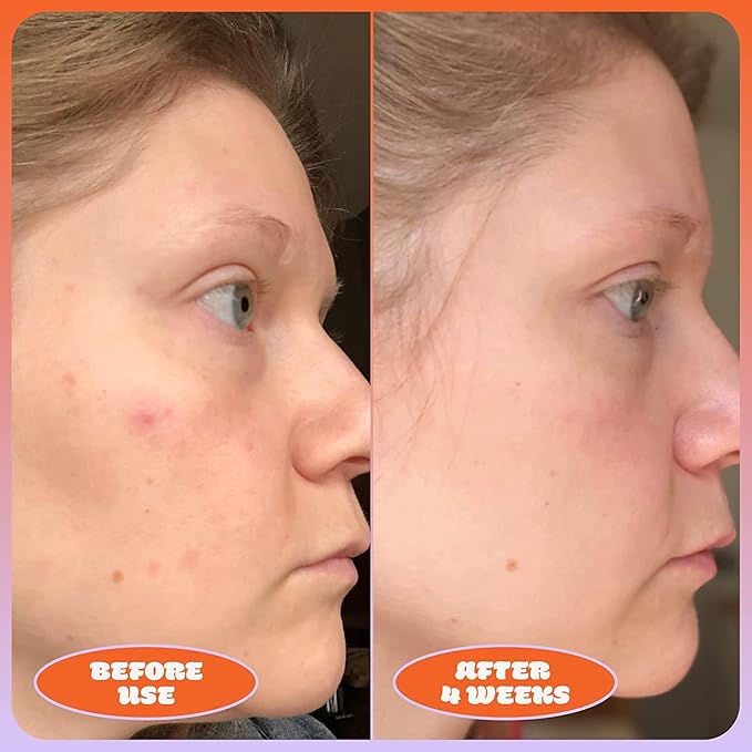 Blume Milky Fade Spot & Scar Fade Serum – Dark Spot Serum – Vegan & Cruelty-Free – Improve Skin Texture, Discoloration and Brightness – Dermatologist-Tested Niacinamide Serum with Hyaluronic Acid