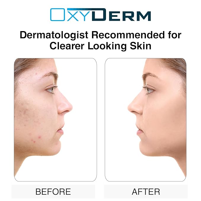 Sulfur Purifying Clay Mask- Deep Pore Cleansing Treatment. Clears Away Acne Blemishes, Clogged Pores, Scars, Oily Skin, Whitehead & Blackhead Pimples for Face & Body with Natural Healing.