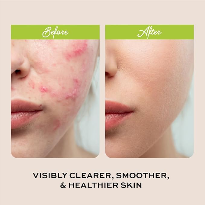 Clarifying Face Wash with Salicylic Acid - Facial Cleanser for Oily, Normal, and Combination Skin - Exfoliating, Pore Minimizing Formula for Teens