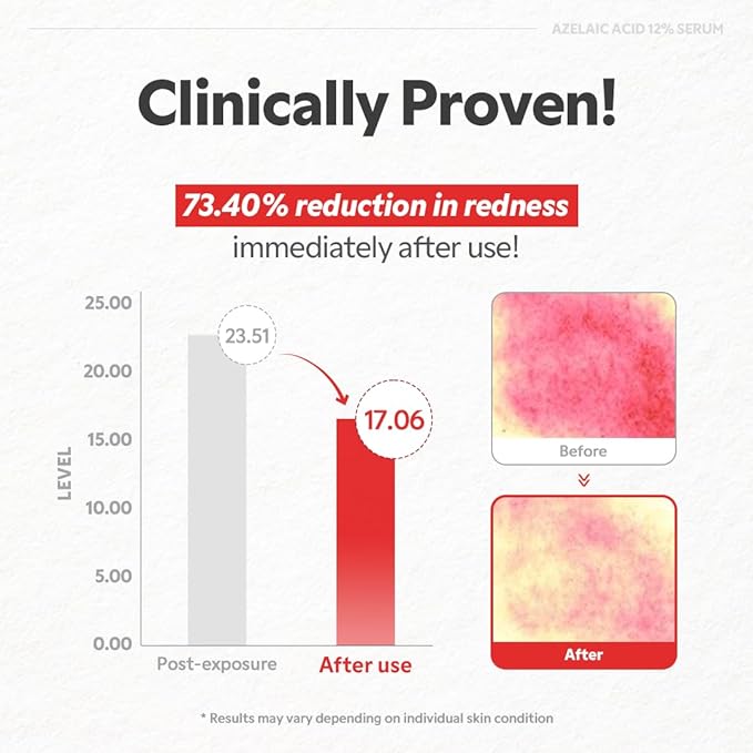 TIRTIR Azelaic Acid 12% Serum for Blemish-Prone Skin - Lightweight Hydrating Formula with Zinc PCA & Hyal-ZIP, Non-Comedogenic, Fragrance-Free, 30ml / 1.01 Fl Oz