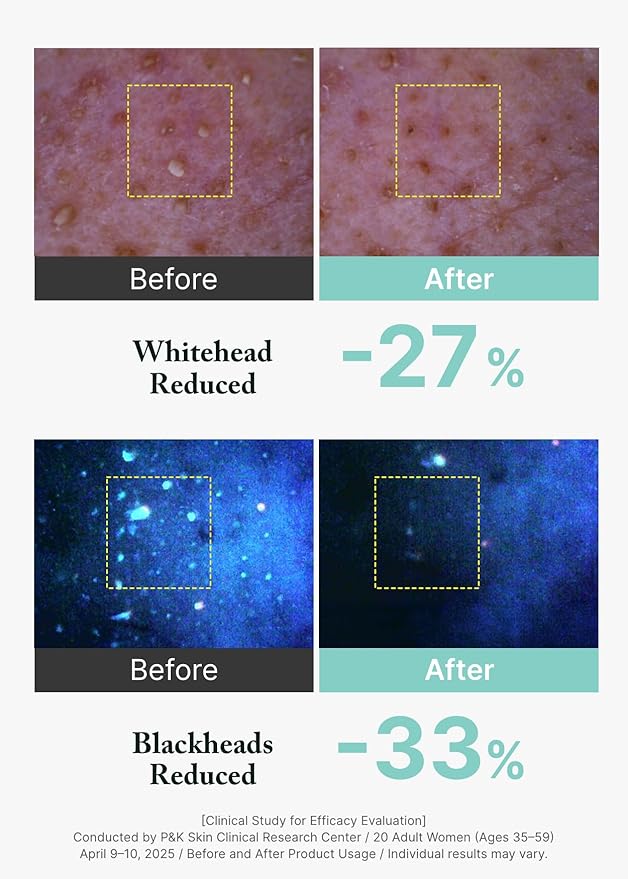 AROMATICA Super Tea Tree Clay Mask Cleanser, Blackhead Remover & Pore Minimizer for Face, Korean Face Wash with Tea Tree Oil, 2 In 1 Acne Skin Care Clay Mask & Cleanser, Oil control (5.0 fl oz)