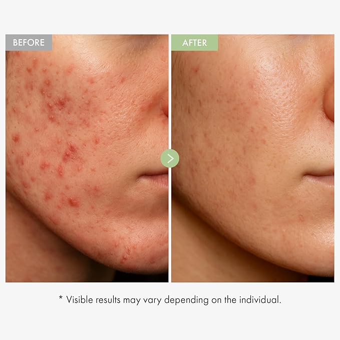 TOSOWOONG Exosome CICA Face Cream - Daily Soothing Moisturizer for Breakouts and Irritated Skin, Fast-Acting, Lightweight Korean Skincare for Redness and Blemish-Prone Skin, 50ml / 1.69 fl. oz.