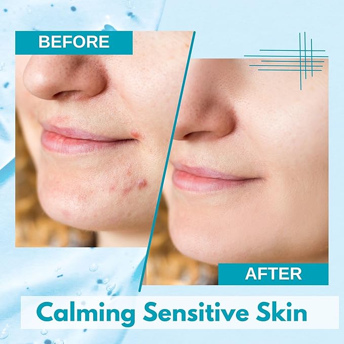 Lululun 28EA Hydrating Face Mask for Acne-Prone Skin & Sensitive Skin, Natural Face Mask for Women & Men with Azelaic Acid & Bifida Ferment, Daily Facial Mask Sheet & Sheet Mask from Japan, Hydra-AZ