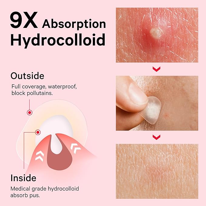Sosky Pimple Patches for Face, Invisible Hydrocolloid Acne Patches, HSA Store Eligible Items, Zit Sticker for Face and Skin, Pimple Sticker for Covering Zits, Blemishes with Salicylic Acid 48 Count