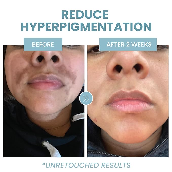 Eva Naturals Azelaic Acid Serum for Face – Niacinamide, Hyaluronic Acid, Vitamins A+C+E – Redness Relief, Dark Spots, Uneven Skin Tone, Texture, Pores, Topical Booster for Clearer Skin, 2oz 2 Pack