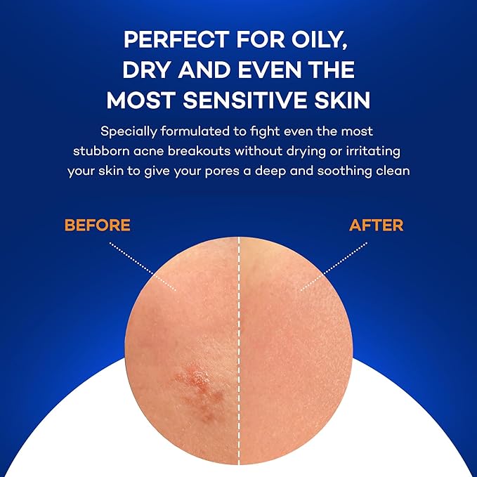 ZocuZap Acne Face Wipes - Moisturizing Face Cleansing Wipes for Acne, Makeup Removal, and Exfoliation with Natural Okra Complex for Sensitive, Rosacea Skin - 15/ct