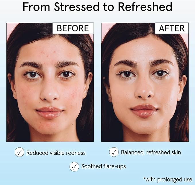 grace & stella Hypochlorous Acid Spray for Face - Acne Spray - Gentle Face Mist to Calm Redness, Flare-Ups, Breakouts, Body Acne, Bacne - Soothing Facial Mist for Sensitive Skin (120ml/4 fl oz)