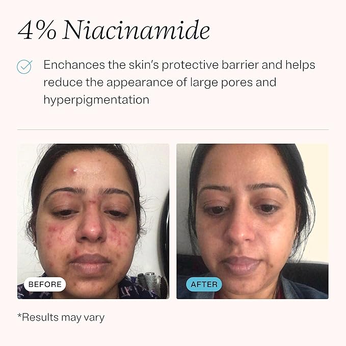 MDacne Retinol 0.5% and Niacinamide 4% Cream (3-pack), Reduces Blemishes and Improves Skin Texture without Irritation