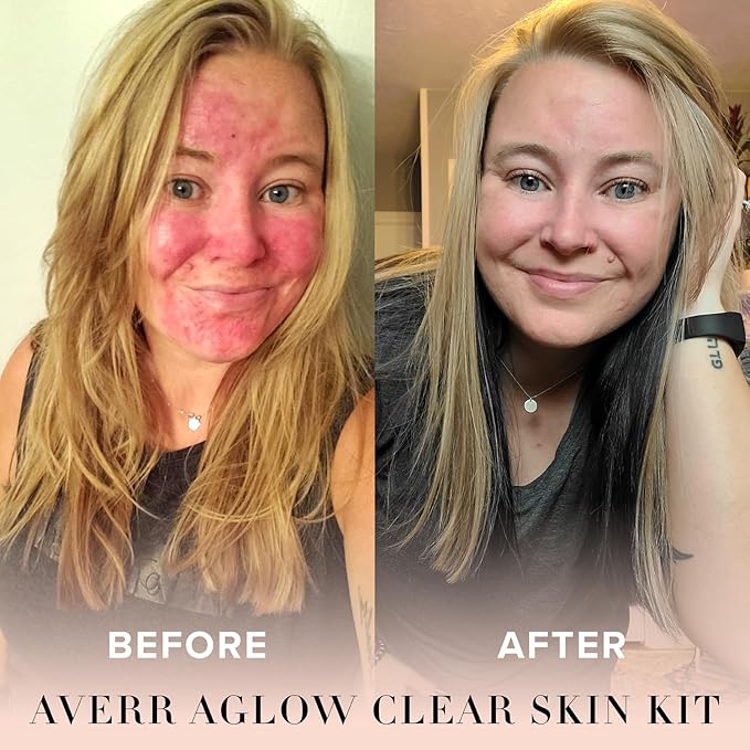 Averr Aglow - Clear Skin Kit - Acne Treatment - Dark Spot Remover - Blemish & Redness Control - Hydrating & Moisturizing - Rich in Minerals, Antioxidants & Vitamin A, C, D & E - Skin Care - 4 pc Set