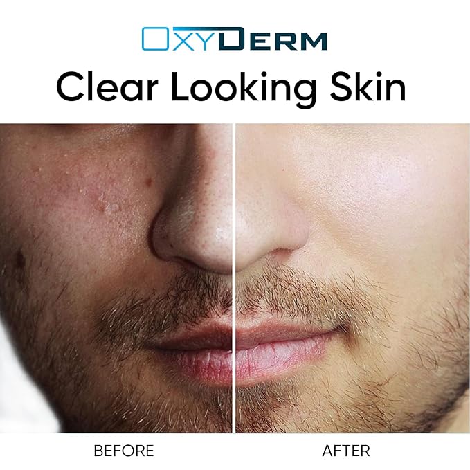 Sulfur Purifying Clay Mask- Deep Pore Cleansing Treatment. Clears Away Acne Blemishes, Clogged Pores, Scars, Oily Skin, Whitehead & Blackhead Pimples for Face & Body with Natural Healing.