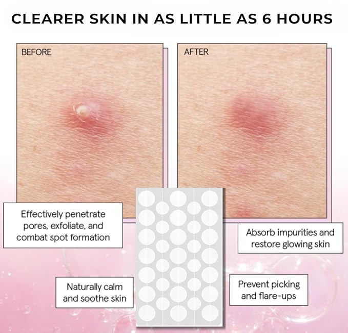 Pimple Patches- Advanced Skincare Treats Acne and Blemishes. Hydrocolloid Spot Treatment with Salicylic Acid & Tea Tree Oil- Acne Patch for Face- 72 ct