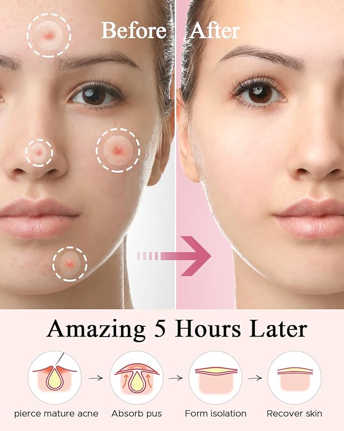 TKTK Hydrocolloid Acne Patches, Pimple Patches for Face with Tea Tree & Calendula Oil - 4 Sizes Clear Cover Stickers, Invisible for Day & Night Use (360 Count)