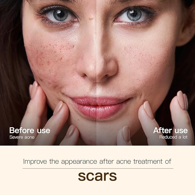 Organic Rosehip Oil, Facial Anti-Aging, Rosehip Oil for Face, for Scars, Natural Extraction of Bakuchiol, Moisturizing&Uniform Skin Tone, for all Skin Types- 30ML