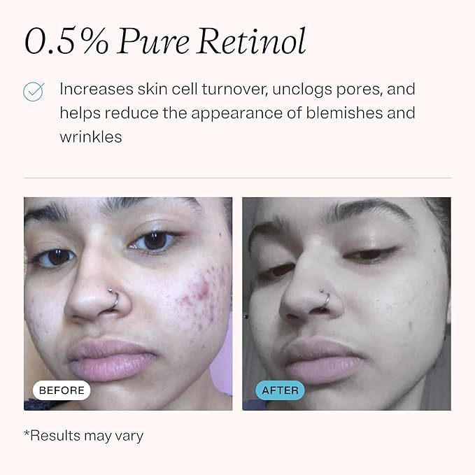 MDacne Retinol 0.5% and Niacinamide 4% Cream (3-pack), Reduces Blemishes and Improves Skin Texture without Irritation