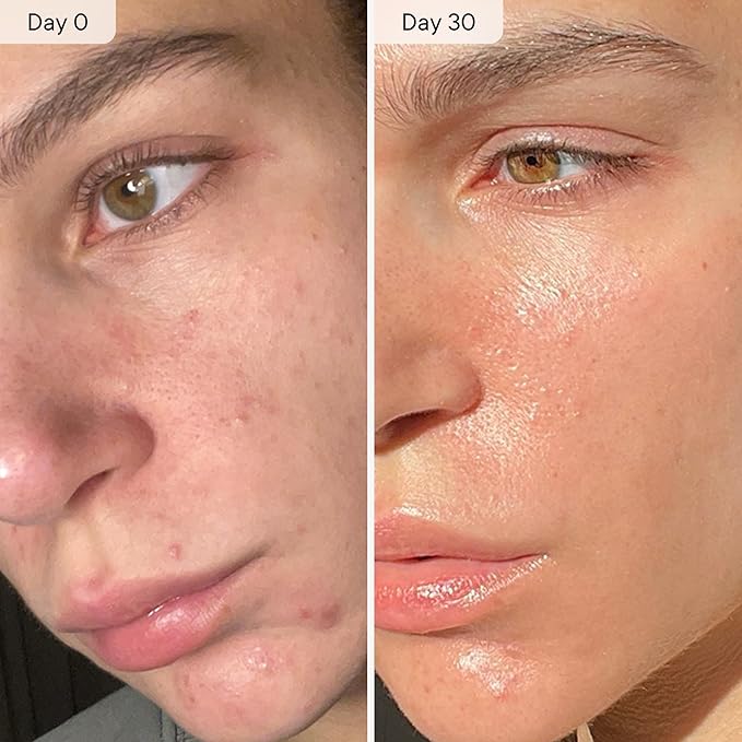 Qure Micro Infusion System for Face & Neck - Facial Moisturizing Essence, Even-looking tone, Serum for All Skin Types, Refreshed and Luminous Skin - 2-Month Supply