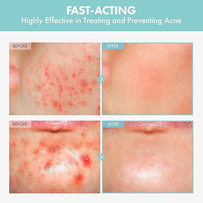 Heartleaf Tea Tree Tok, Acne Treatment, Soothing Toner Serum, Centella Asiatica, Korean Facial Skincare for Pore Control, Calming, Nourishing. 50ml, 1.69 fl. oz.