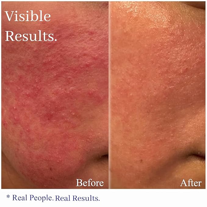 Hey Honey Skincare Relax - Rosacea Relief Cream for Sensitive Skin | Calming Face Moisturizer for Facial Redness & Irritation | Dermatologist Tested, Oil-Free with Honey & Propolis | 2.2 Oz