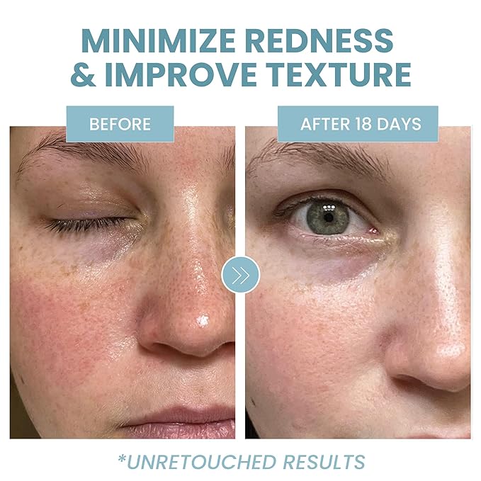 Eva Naturals Azelaic Acid Serum for Face – Niacinamide, Hyaluronic Acid, Vitamins A+C+E – Redness Relief, Dark Spots, Uneven Skin Tone, Texture, Pores, Topical Booster for Clearer Skin, 2oz 2 Pack