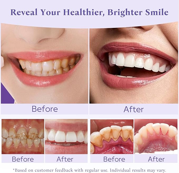 Teeth Whitening Powder,Remineralizing Hydroxyapatite Tooth Powder with Niacinamide,R5X Purple Color Corrector for Instant Brightening, Enamel Repair & Long-Lasting Natural White-30g