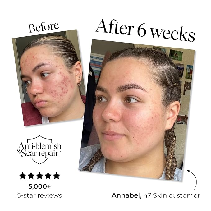 | Hydrating Face Serum with Silver Chitoderm for ALL Skin Types | Clears Acne, Prevents & Heals Breakouts & Blemishes, Repairs Scars | Moisturises and Nourishes For Smooth Skin | 30ml