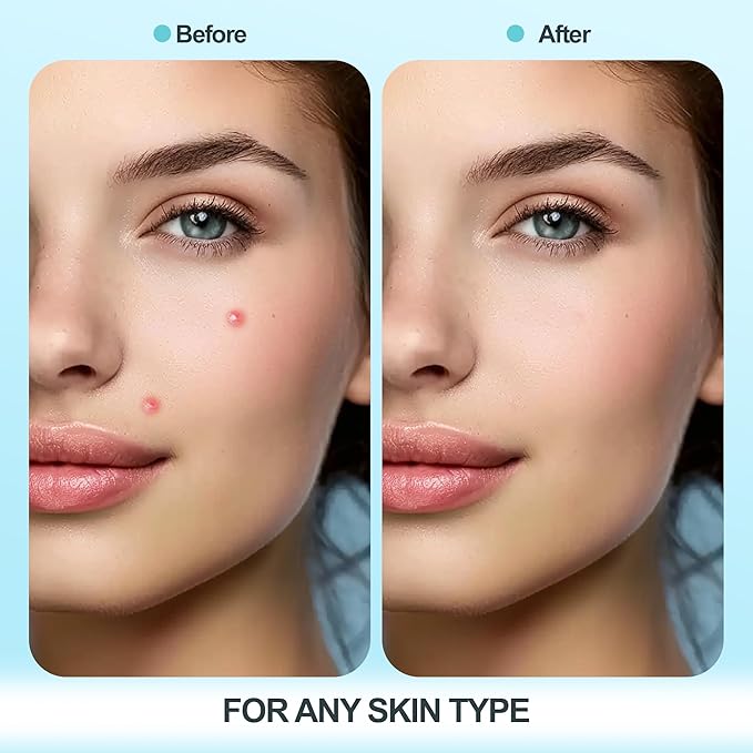 Pimple Patches for Face 5pack,Hydrocolloid Acne Pimple Patches for Covering Zits and Blemishes