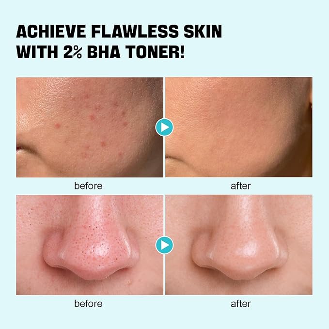 Salicylic Acid Toner, Blackhead Remover, BHA Liquid Exfoliant (CICA, 6.76OZ), ZealSea Pore Minimizer for Face, Gentle Alcohol Free BHA Toner for All Skin Type with Niacinamide, Redness Relief, Vegan