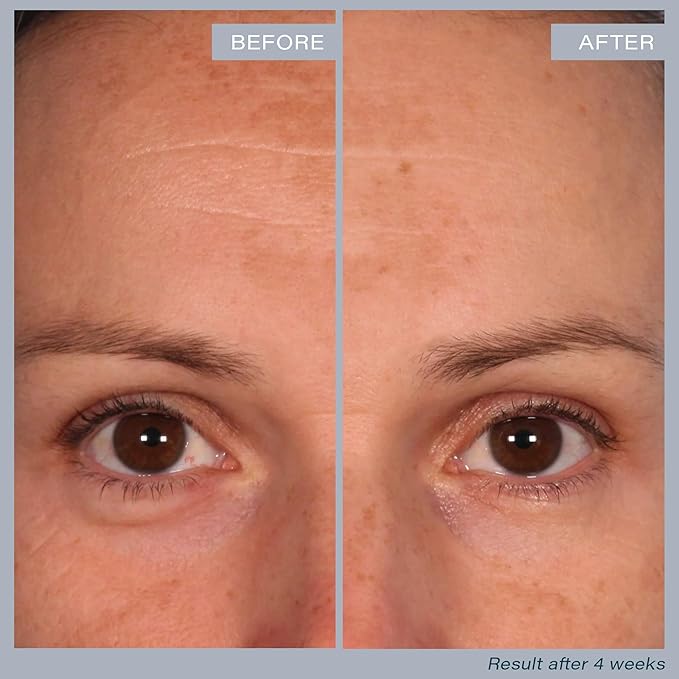 SKINN Multi-Acid Resurfacing Pads, with Glycolic, Lactic & Salicylic Acid, 60 Pads - Witch Hazel Chemical Peel for Face, Neck & Decollete Exfoliates, Brightens & Tones Skin, for Fine Lines & Wrinkles