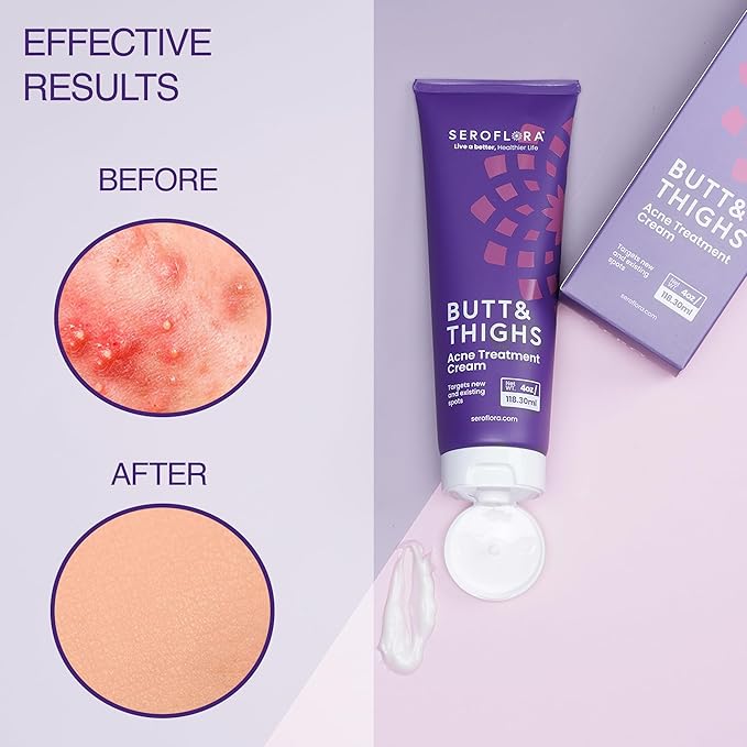 Butt Acne Clearing Treatment Cream - Reduce Bum Acne, Pimples & Zits - Clearing Acne Lotion for Buttocks - 2% Salicylic Acid for Acne Prone Skin (4oz) Made in USA.