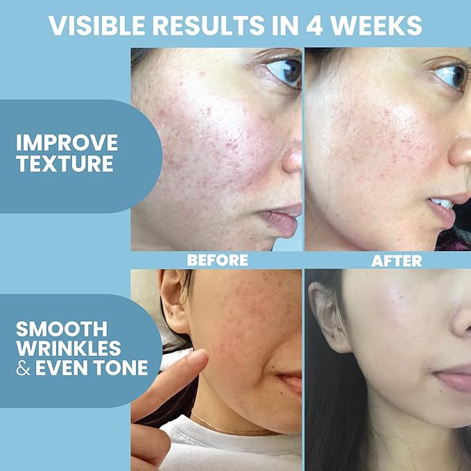 Collagen Peptide Serum for Face – Anti Aging Facial Treatment with Peptides & Hyaluronic Acid – Gentle Formula for Sensitive Skin, Microneedling Pen, Derma Roller, Skin Firming & Hydrating (1 Oz)