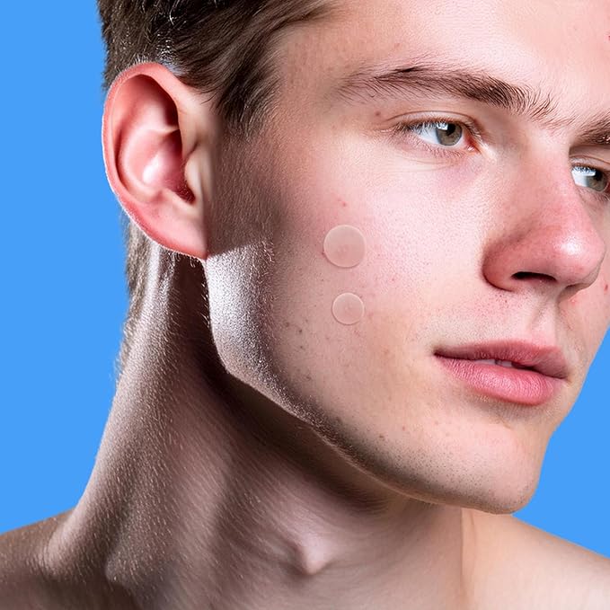AVARELLE Pimple Patches for Face | Hydrocolloid Acne Patches for Covering Blemishes | Zit Patches with Tea Tree, Calendula, & Cica | HSA Store Eligible Items (10-14 mm, 80 Count)