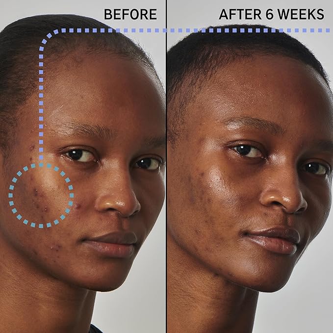 The INKEY List SuperSolutions Niacinamide 20% Serum, Helps with Healthy-Looking Skin Texture, Pores and Balancing Excess Oil, Skin Barrier Protection 1.01 fl oz