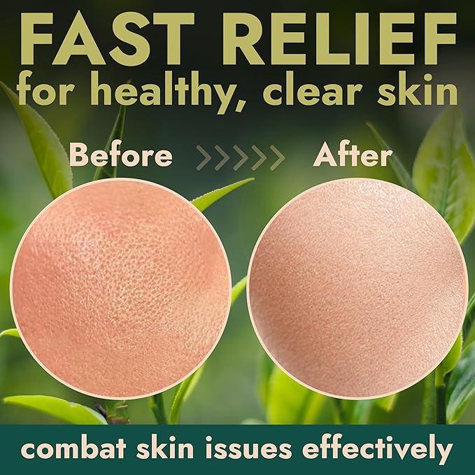 Blackhead Remover Mask With Tea Tree Oil | Clay Mask | Pore Minimizer for Face with Volcanic Ash | Soothes Redness & Irritation | Smooths Skin | Deep Cleansing Facial Treatment for All Skin Types