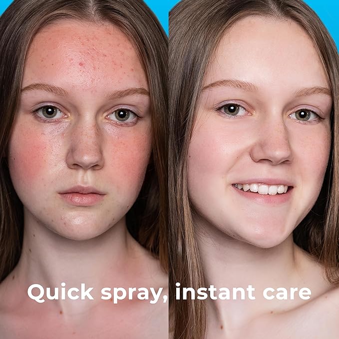 Hypochlorous Acid Spray for Face (8oz, Reduces Acne), Targets Bacteria - HOCL Facial Cleanser Acne Spray for Face, Body, Eczema, Pimples, Breakouts & Overall Skin Recovery (Reduces Redness)