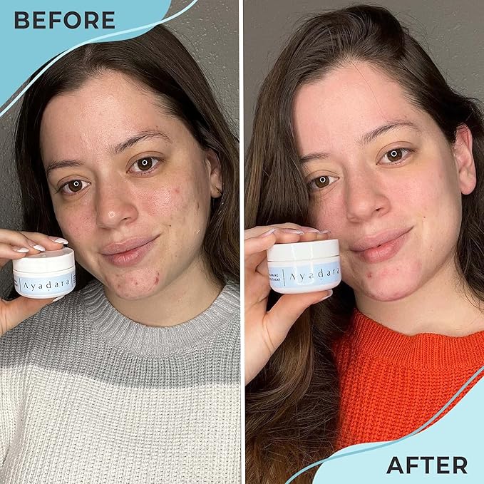 Warrior One (0.5oz) Acne Spot Treatment with 2% Salicylic Acid, Cystic and Hormonal Acne Cream, Acido Salicilico Acne Spot Treatment for Face, acne Cream for Adults and Teens, 150+ Uses