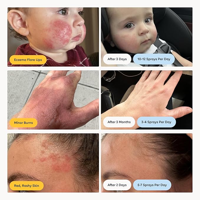 Magic Molecule Hypochlorous Acid Spray for Breakout-Prone Skin, Eczema & Itchy Rashes | Helps 50+ Dermal Issues | Safe for Multiple Daily Uses | For All Skin Types | 8 oz Spray