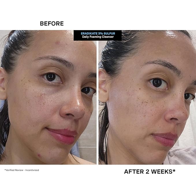 Kate Somerville EradiKate 3% Sulfur Daily Foaming Cleanser Acne Treatment – Clinically Formulated Medicated Face Wash Balances Skin & Cleans Pores, 4 Fl Oz