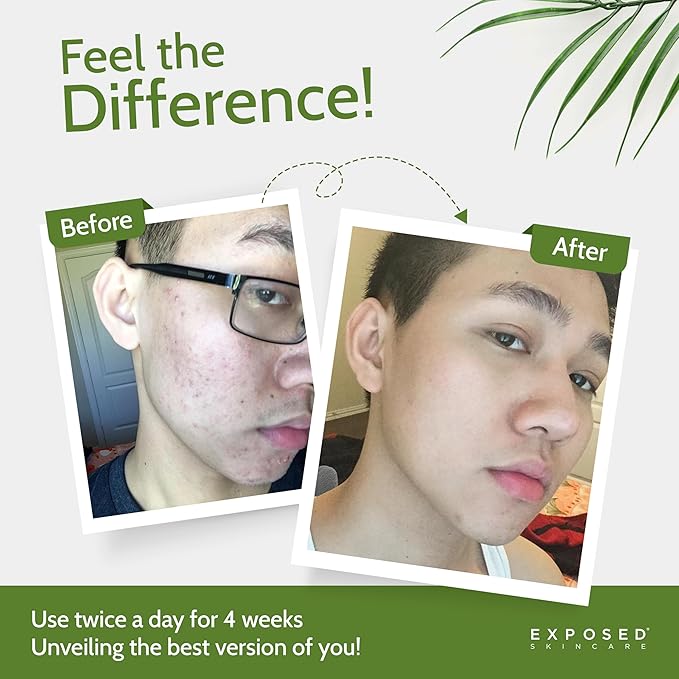 Exposed Skin Care, Clear Pore Serum with 1% Salicylic Acid for Sensitive and Oily Skin – Gently Clears Blackheads, Minimizes Pores and Reduces Excess Oil – Natural, Non-toxic and Cruelty Free