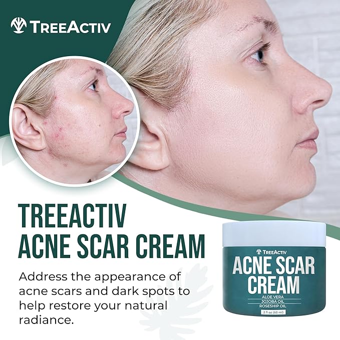 TreeActiv Acne Scar Treatment, 2 fl oz, Scar Cream for Face and Dark Spot Remover, Lotion for Stretch Marks and Body, Acne Scar Removal for All Skin Types, 500+ Uses