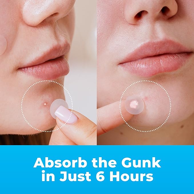 Pimple Patches for Face (500 Patches), Hydrocolloid Acne Patches with Tea Tree Oil, Pimple Patch Pimple Stickers - Hydrocolloid Patch Acne Dots - Acne Pimple Patches For Face - Zit Patches