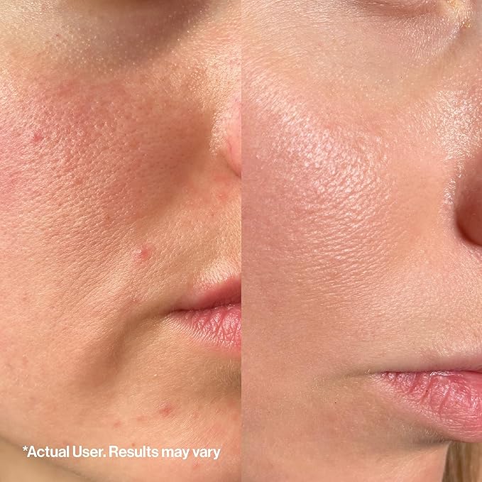 OG Skincare Glow Up Kit – Probiotic Acne Treatment & Radiance Reset Cleanser – Gentle, Microbiome-Friendly, Preservative-Free