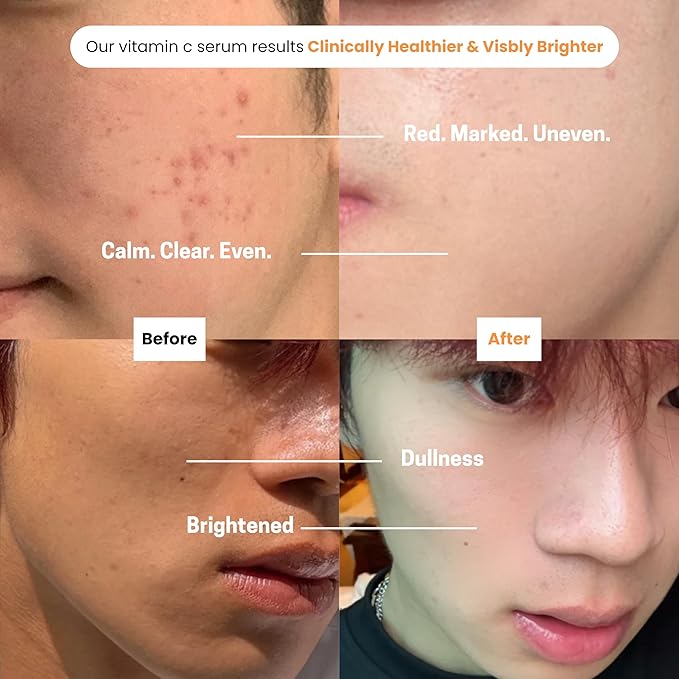 Puréel 20% Vitamin C Serum for Face – Brightening Serum with Vitamin E & Ferulic Acid – Anti-Aging, Dark Spot Remover, Even Skin Tone, Wrinkle Reduction & Radiant Glow – 1 fl oz