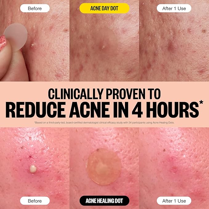 PEACE OUT Acne Day & Night Duo, Sheer Hydrocolloid Pimple Patches For Day Plus Overnight Acne Dots, Helps Clear Blemishes Quickly with Salicylic Acid, Retinol and Aloe Vera, 20 dots